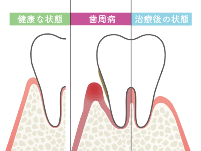 健康な歯と歯周病の歯と治療後の歯を比較した断面図。